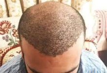 hair transplant