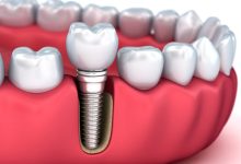 dental implant