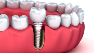 dental implant