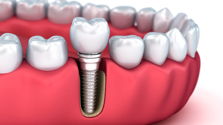 dental implant