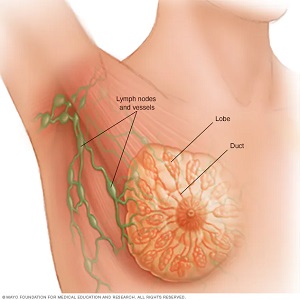 Breast Cancer symptoms