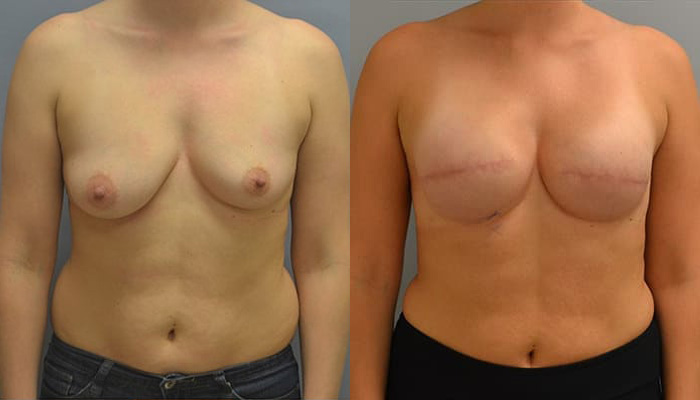 Breast Reconstruction After Mastectomy