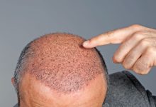 Hair Transplant