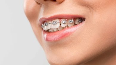 metal braces