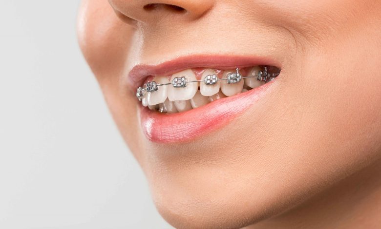 metal braces