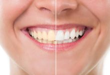 A Complete Cheat Sheet on Teeth Whitening