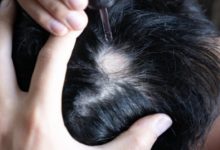 Best Hair Transplant in Delhi NCR