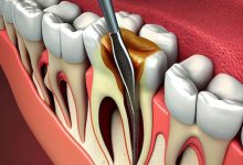 root canal treatment