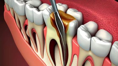 root canal treatment